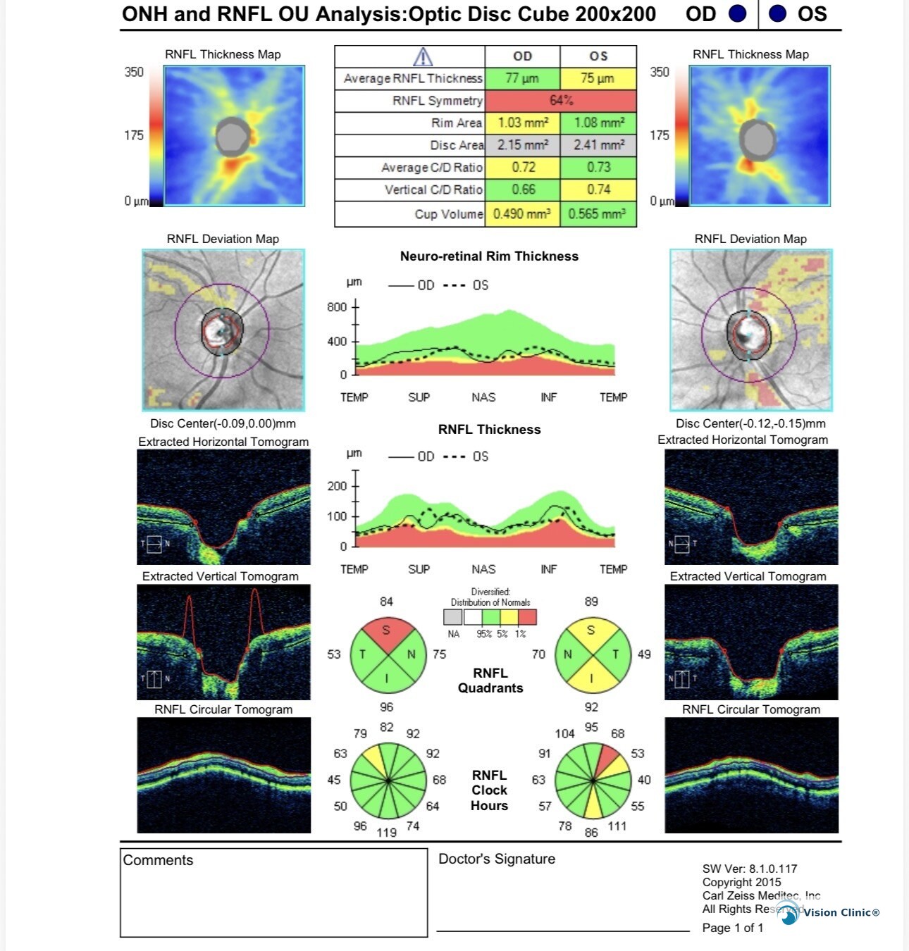 Example of an optic nerve tomography (OCT) study