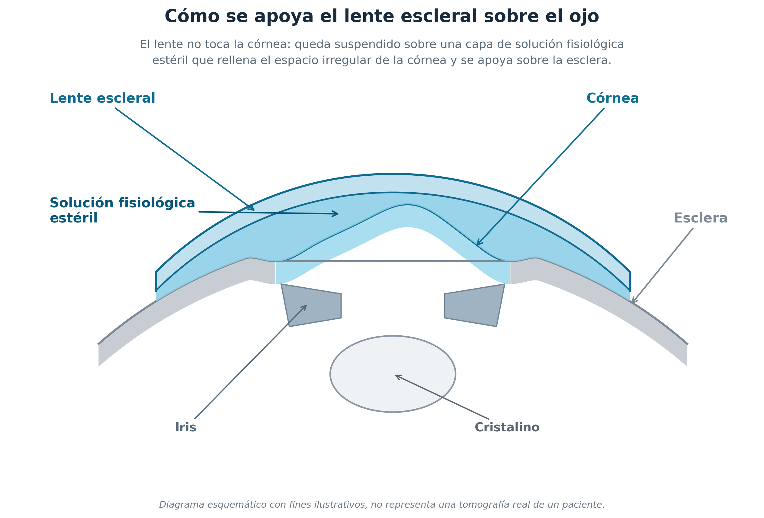 Diagram of how a scleral lens rests on the eye, with sterile saline solution between the lens and the cornea