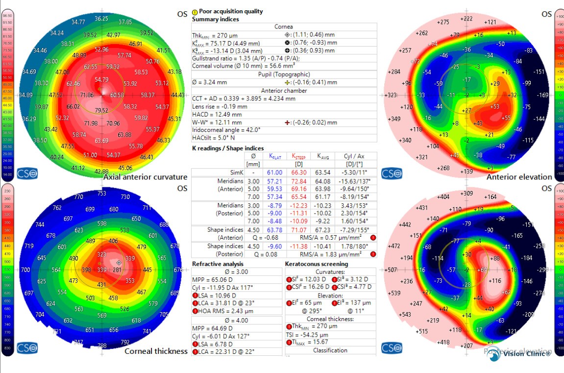 Example of a corneal tomography study for keratoconus diagnosis