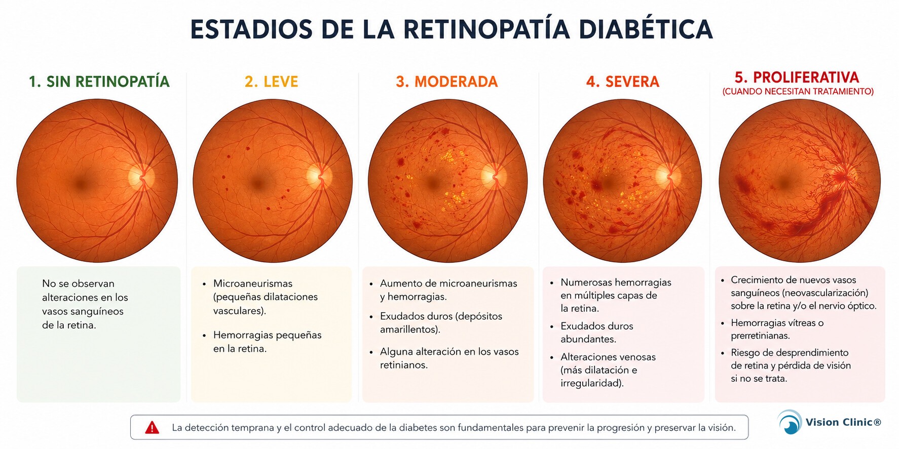 Estadios de la retinopatía diabética, de sin retinopatía a proliferativa