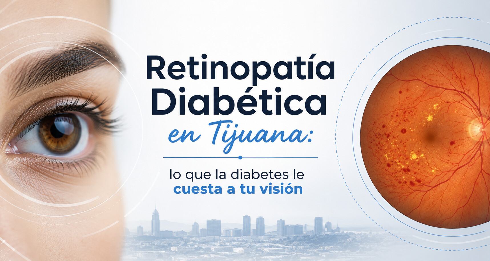 Diabetic Retinopathy in Tijuana: what diabetes costs your vision