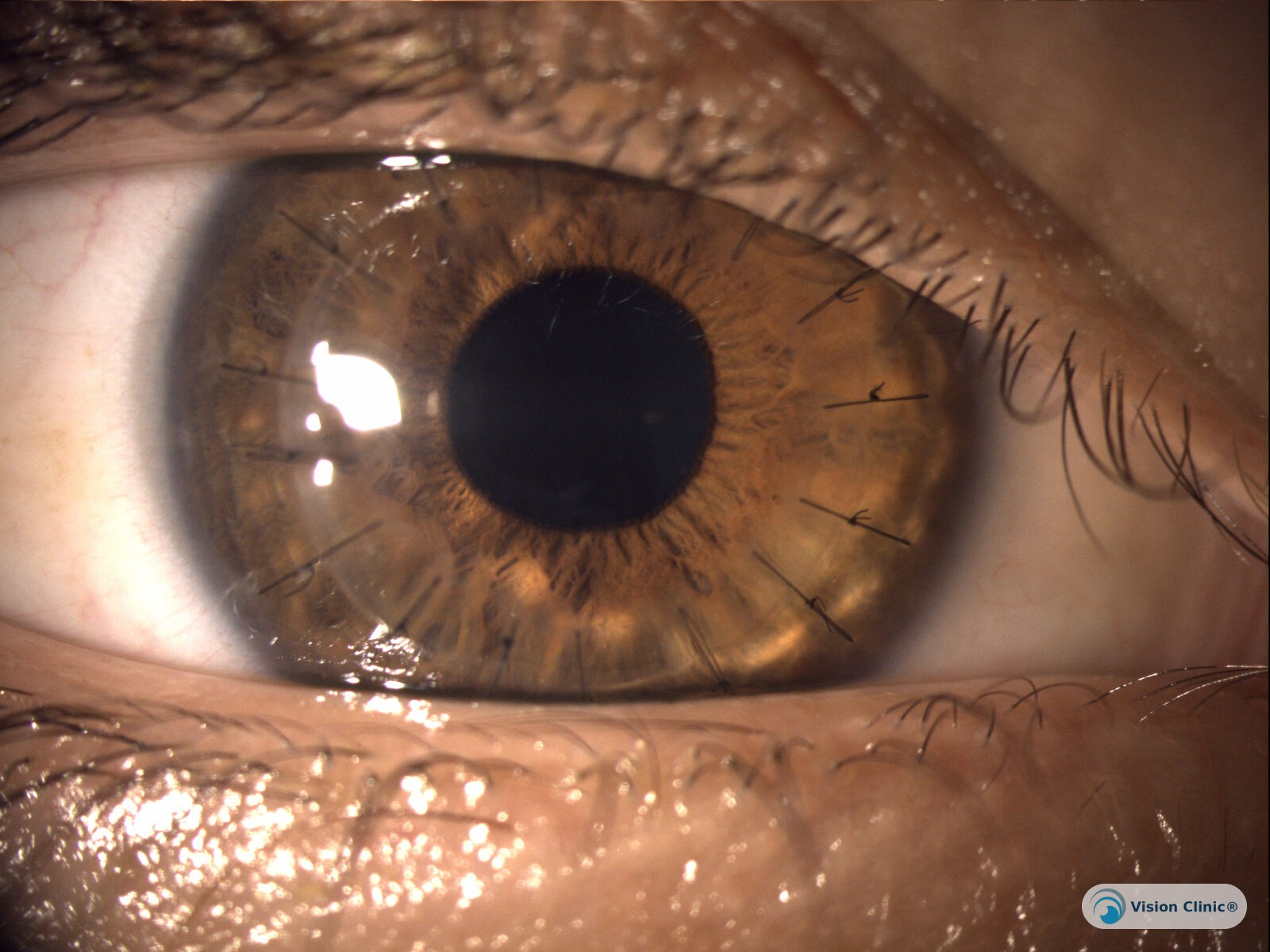 Slit-lamp view of a DALK graft with sutures