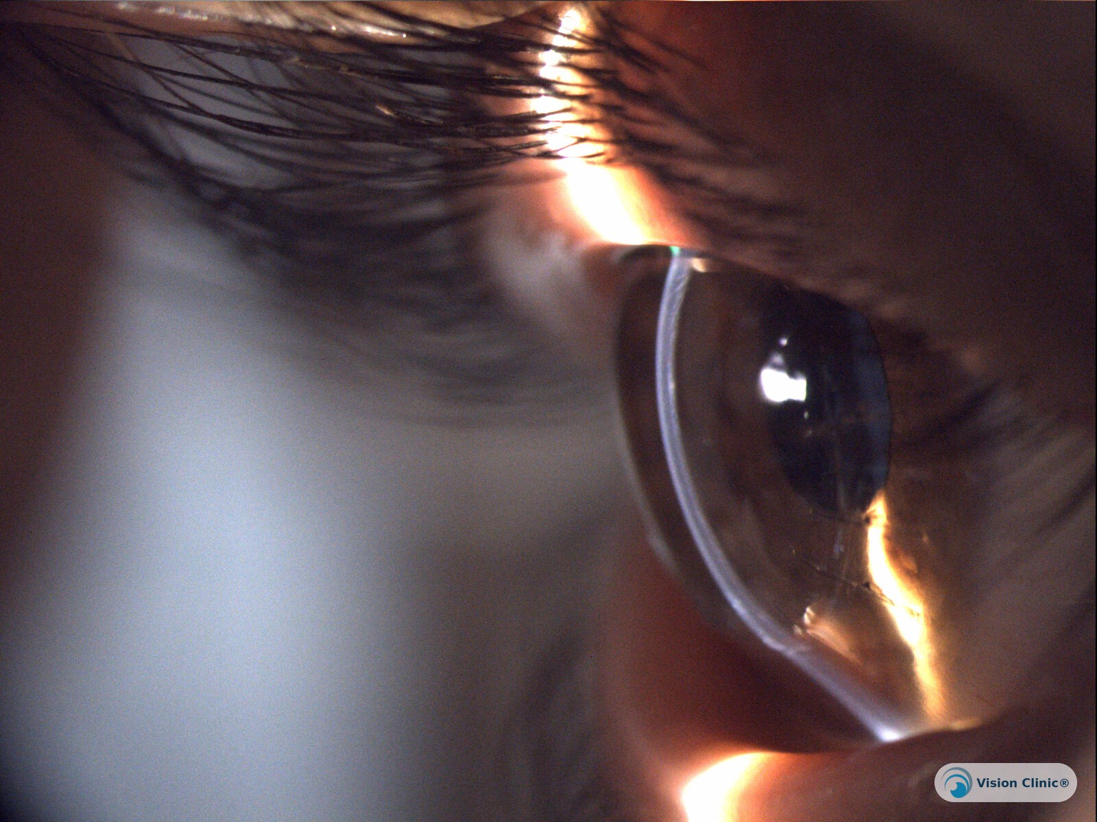 Side view of the corneal contour after a DALK transplant