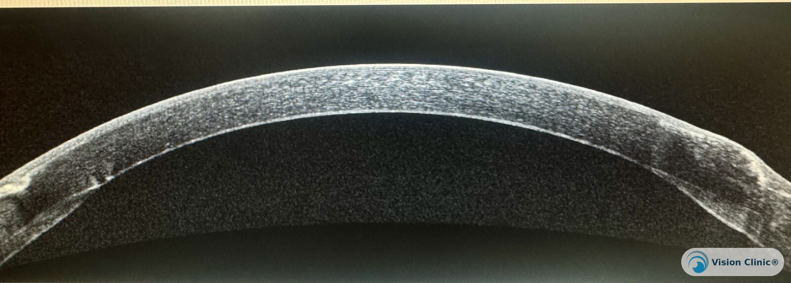 Anterior segment tomography showing the interface of a DALK graft
