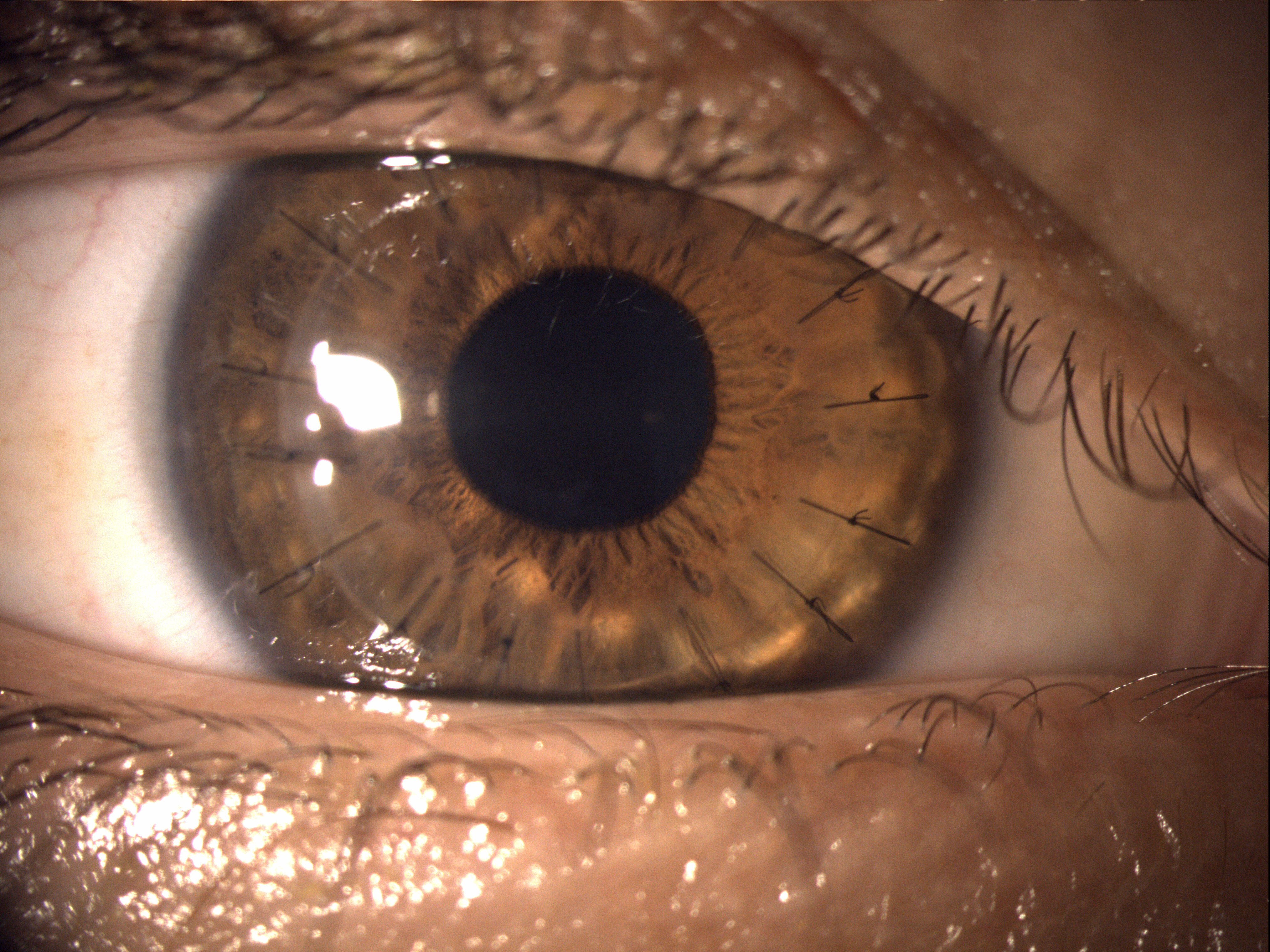 Corneal transplant in Tijuana: modern techniques and recovery