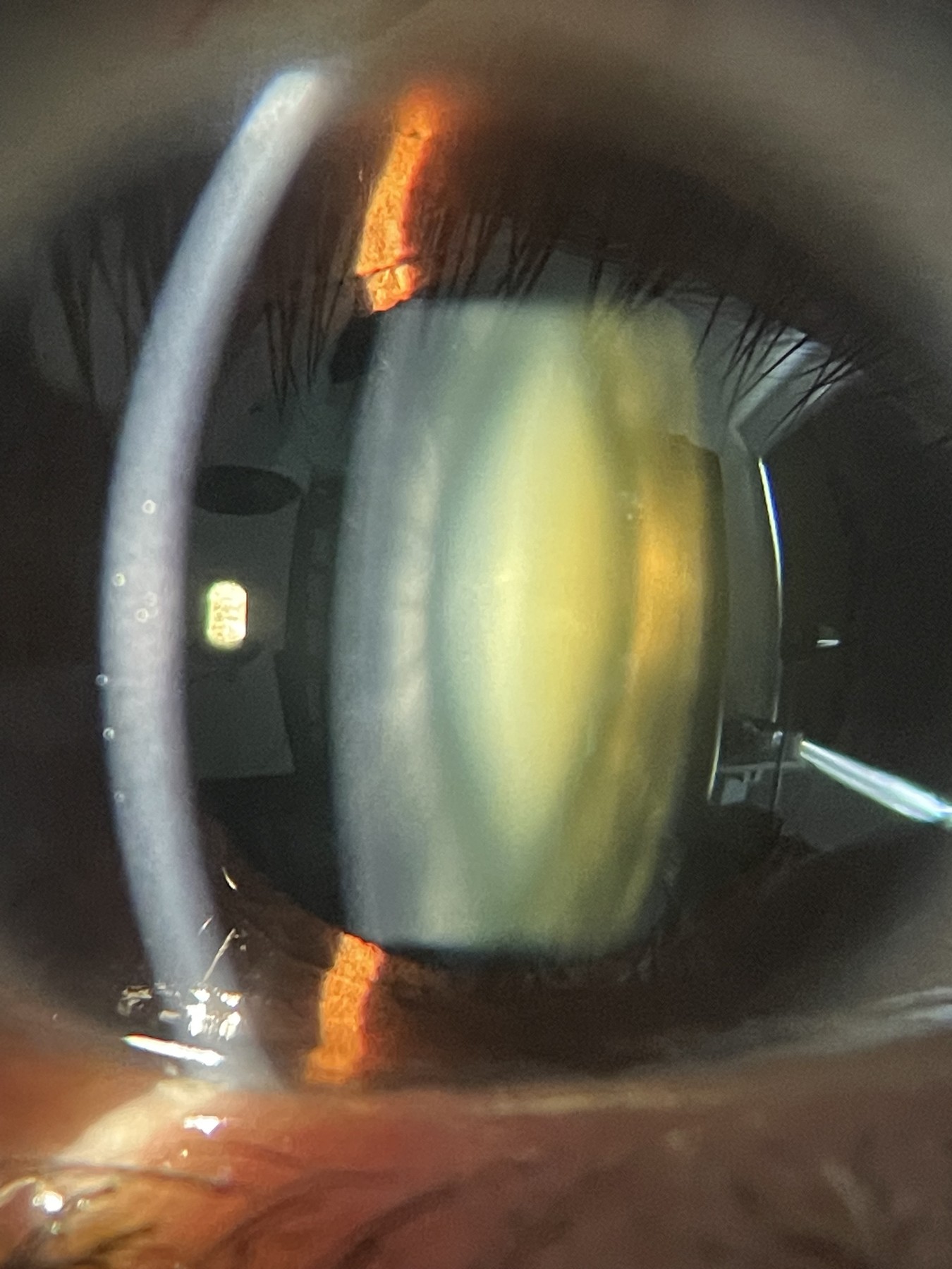 Nuclear cataract