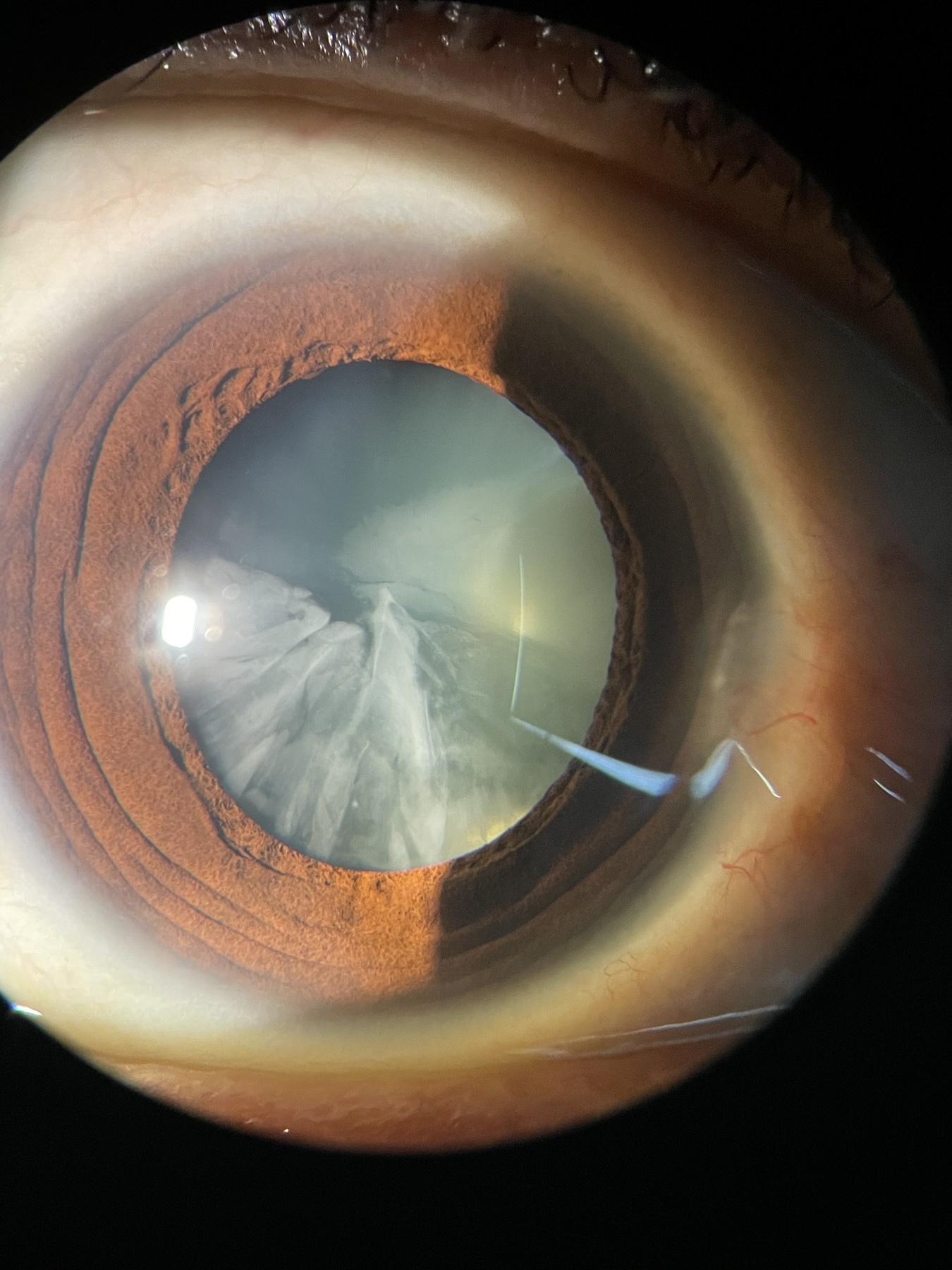 Cortical cataract