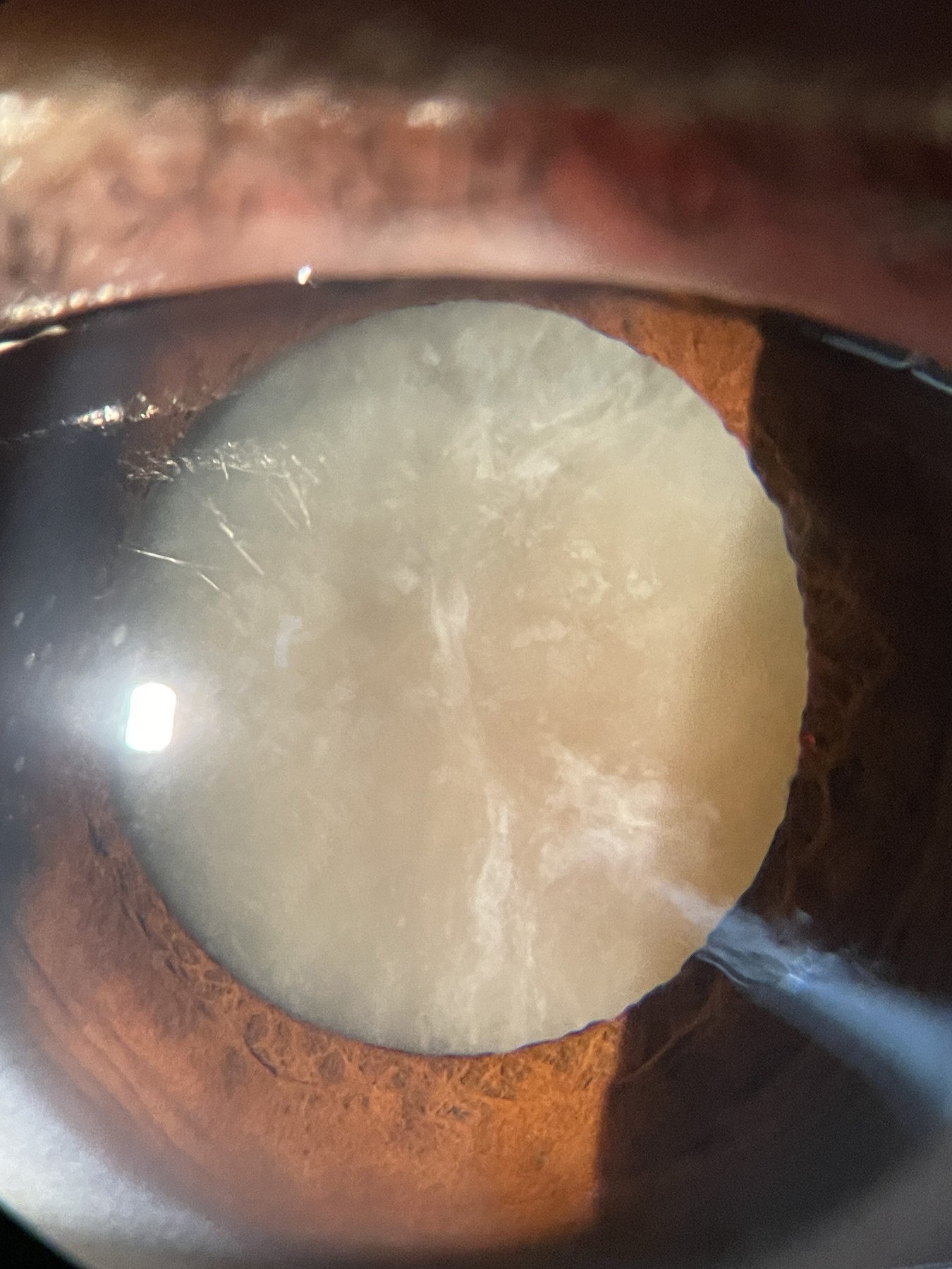 Mature cataract