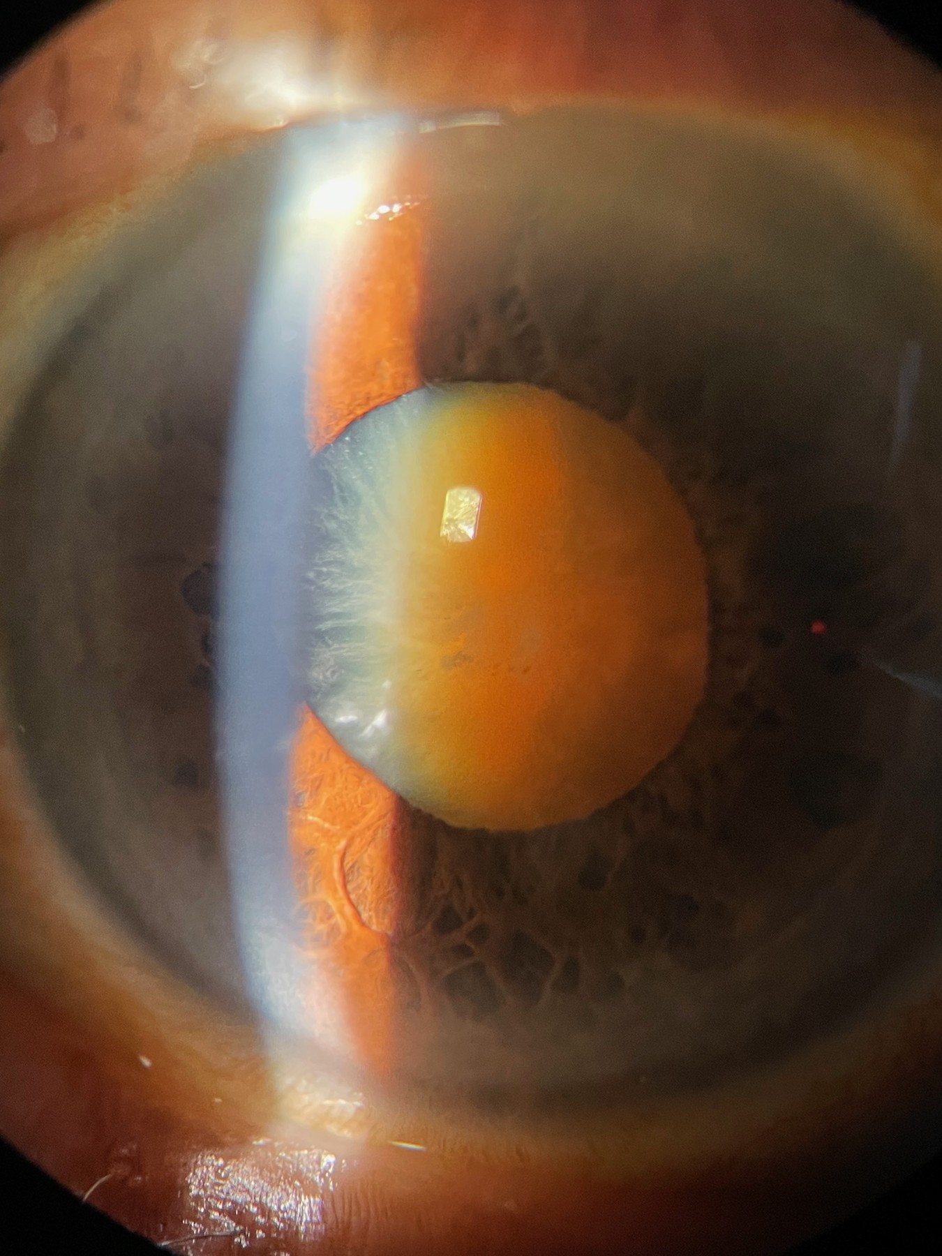 Mature cataract