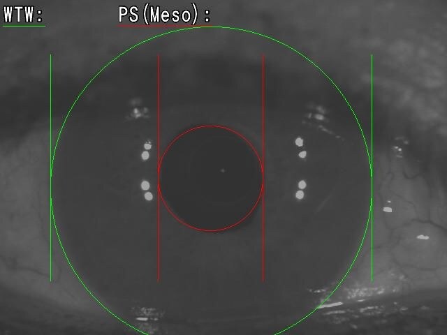 Ejemplo real del estudio en Vision Clinic