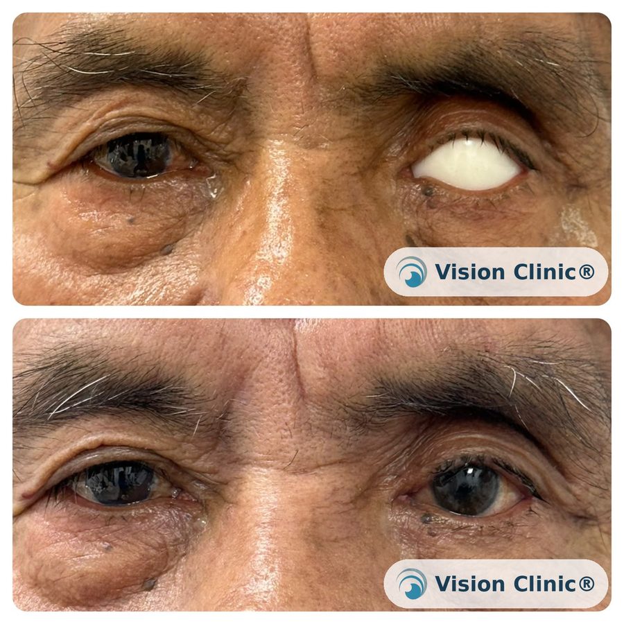 Patient of Dr. Cristina Plata after ocular prosthesis fitting.