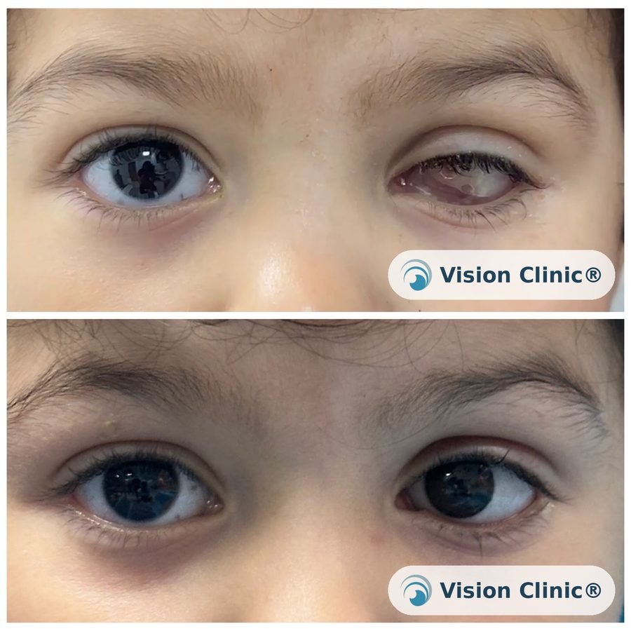 Pediatric patient of Dr. Cristina Plata after ocular prosthesis fitting. Photo published with informed consent from the patient's guardian.