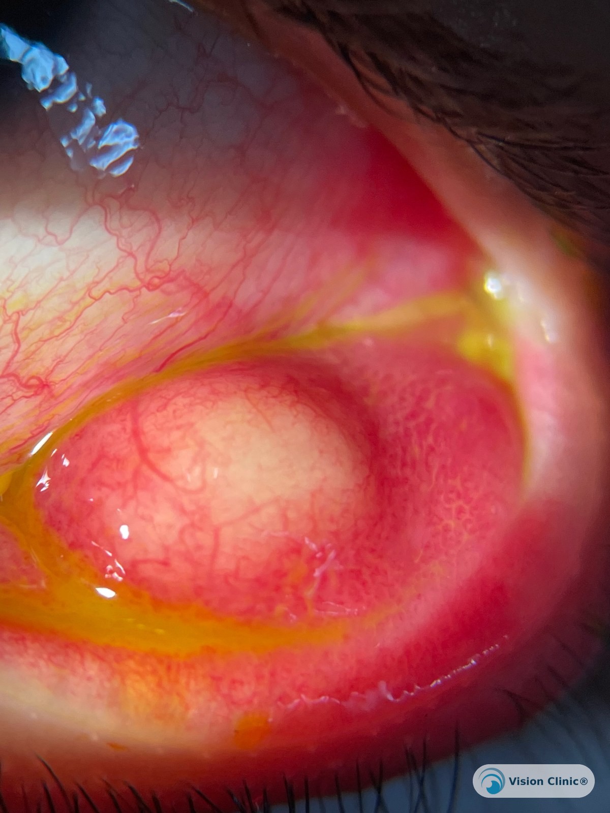 Foto de paciente de Vision Clinic®.