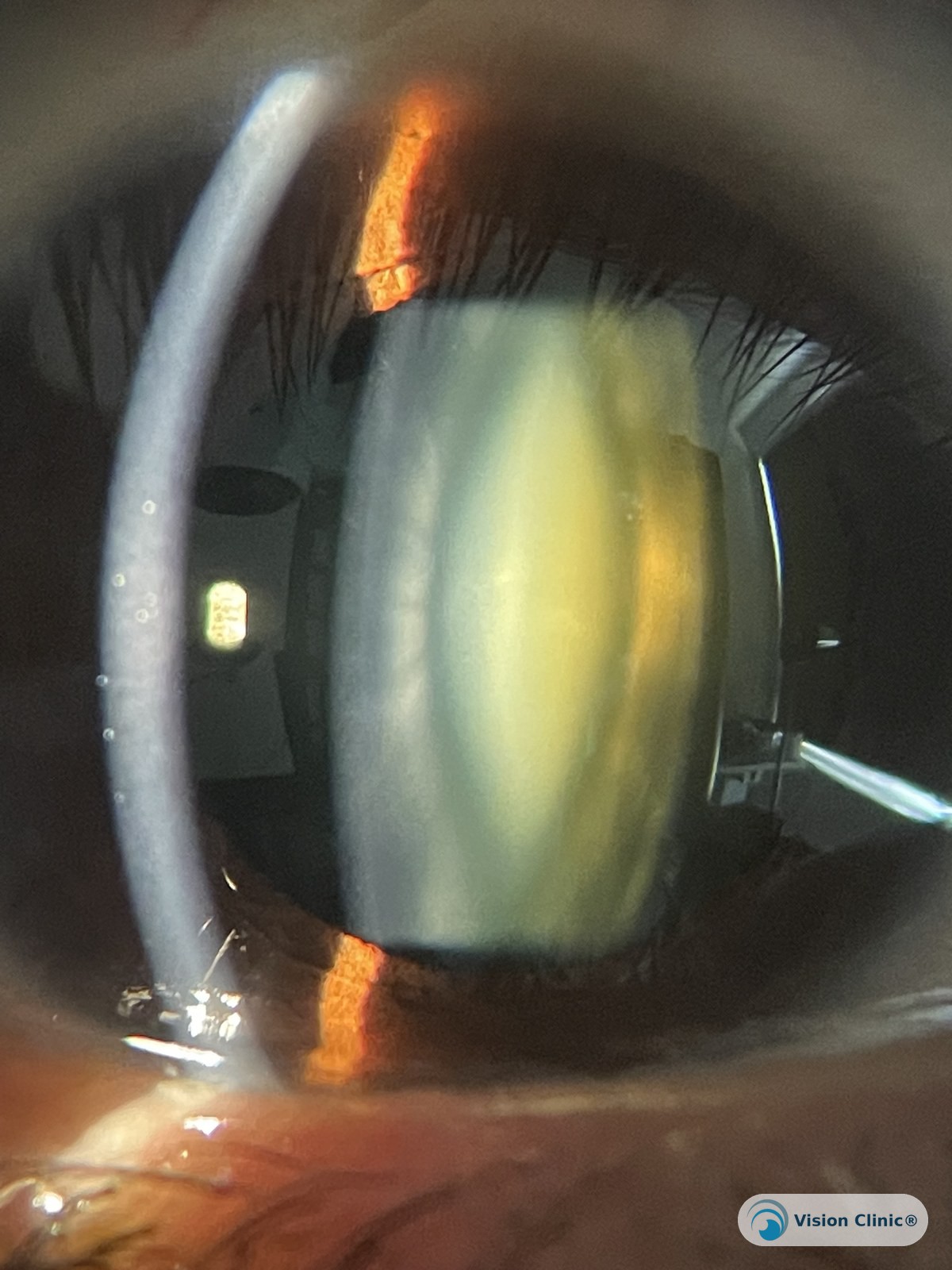 Catarata nuclear: opacificación amarillenta en el núcleo central del cristalino. Paciente de Vision Clinic®.