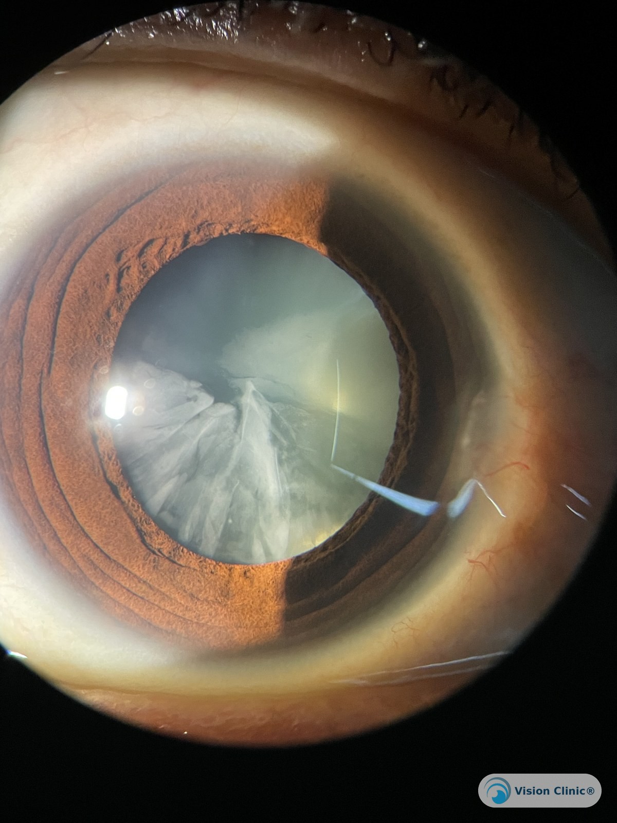 Catarata cortical: opacidades en forma de cuña que avanzan desde la periferia del cristalino. Paciente de Vision Clinic®.