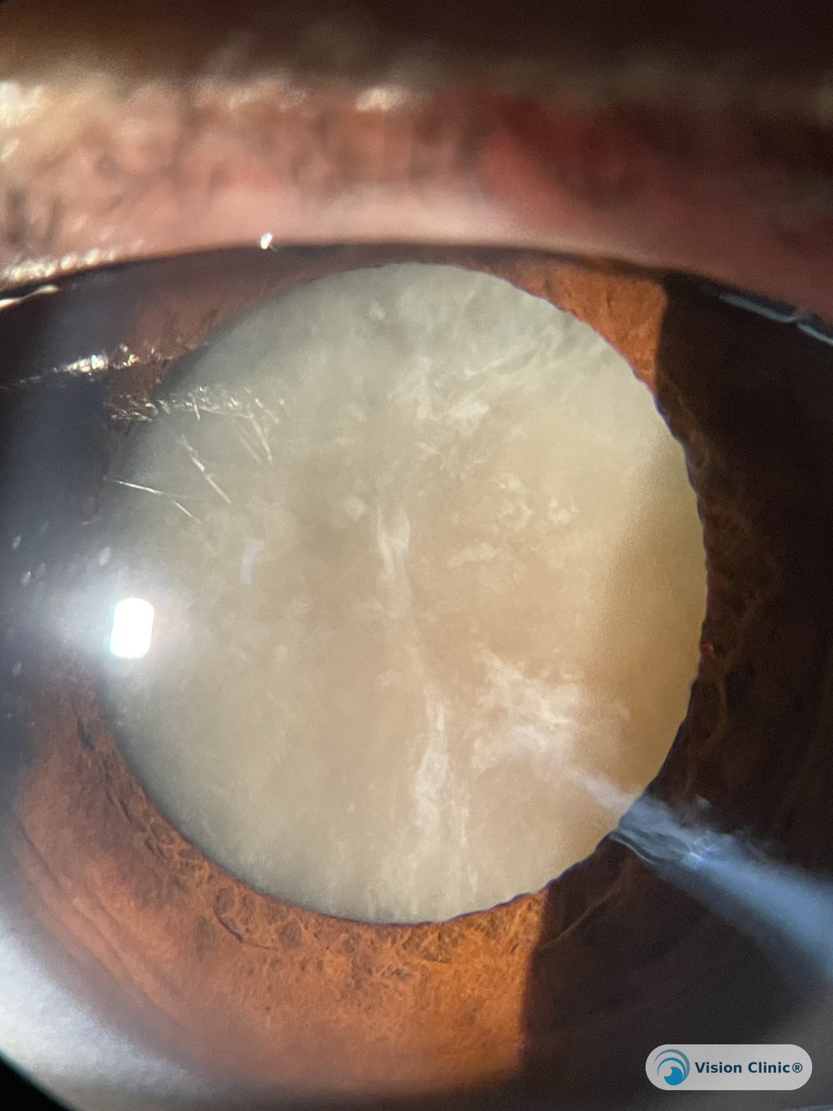 Catarata madura: el cristalino se opacifica por completo, dejando la visión reducida a percepción de luz o bulto. Paciente de Vision Clinic®.