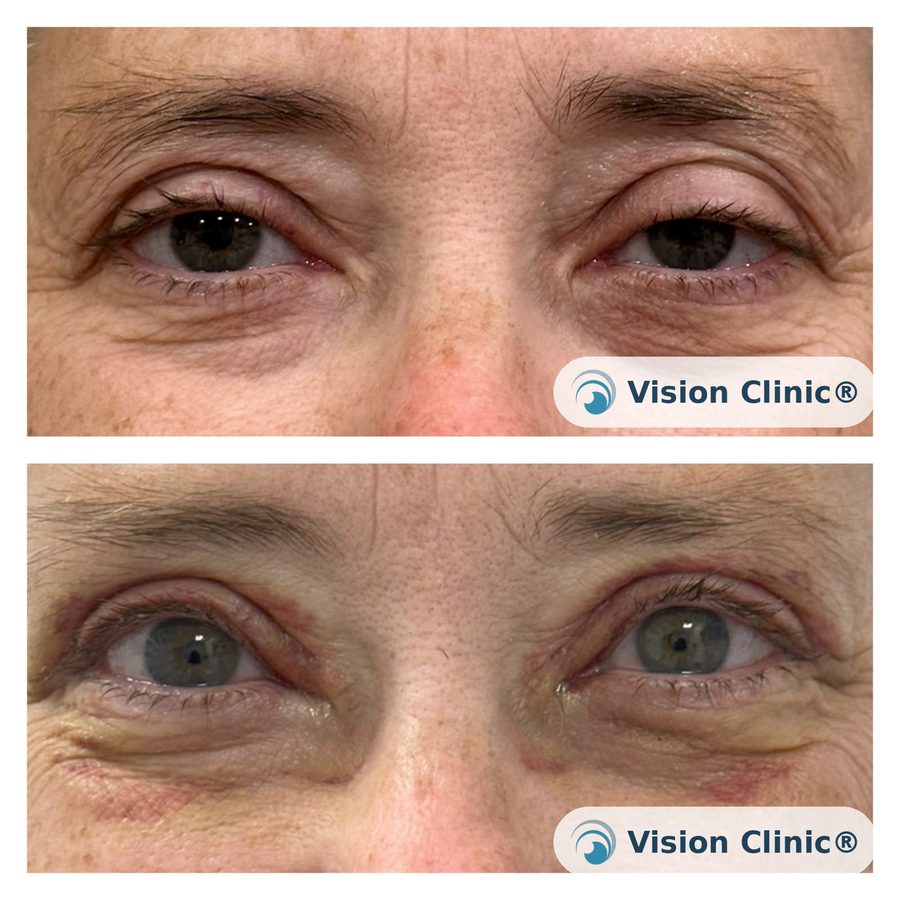 Paciente de la Dra. Cristina Plata tras cirugía correctiva de ptosis palpebral.