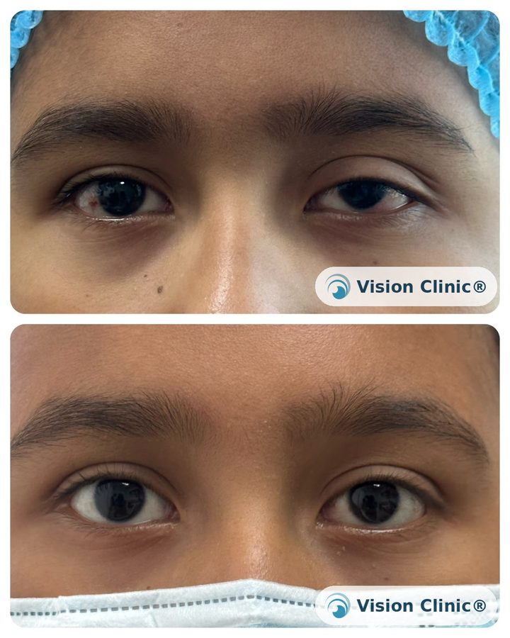 Paciente pediátrico de la Dra. Cristina Plata tras cirugía correctiva de ptosis palpebral. Fotografía publicada con consentimiento informado del tutor.