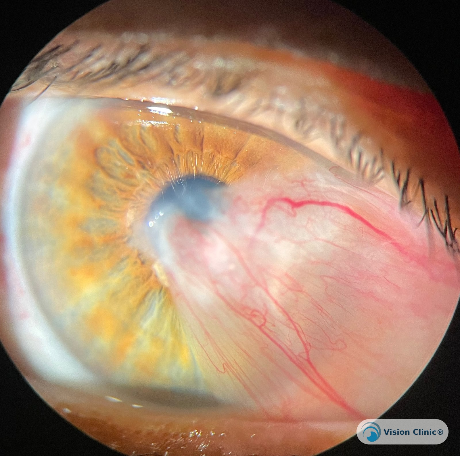 Foto de paciente de Vision Clinic®.