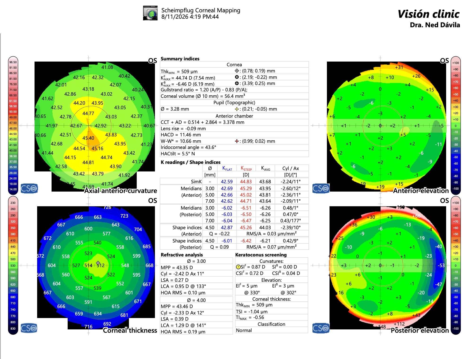 Así se ve un estudio de topografía corneal en Vision Clinic: mide la curvatura, el grosor y la forma de tu córnea con el equipo Sirius Plus.