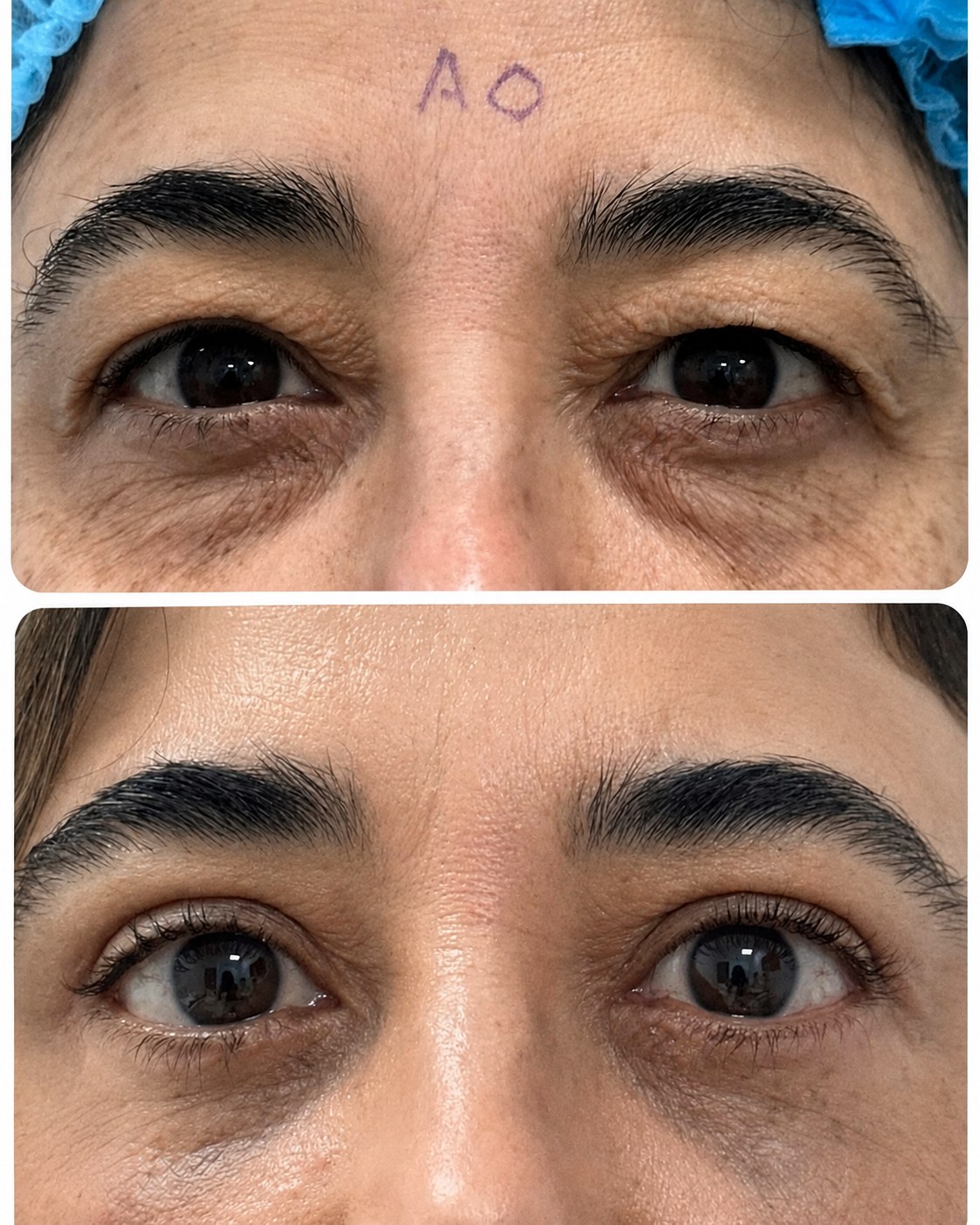 Antes y después de blefaroplastia