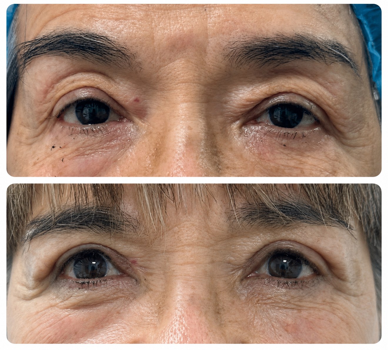 Antes y después de blefaroplastia