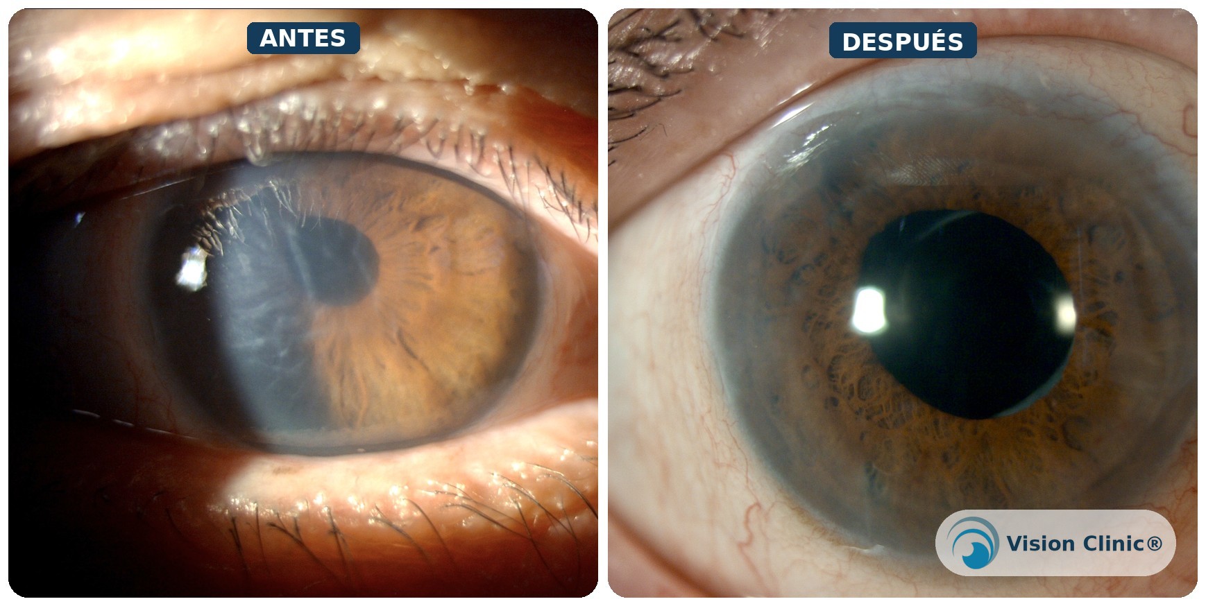 Antes y después: paciente operada por la Dra. Ned Dávila de trasplante lamelar posterior (DSAEK) por descompensación de córnea tras cirugía de catarata.