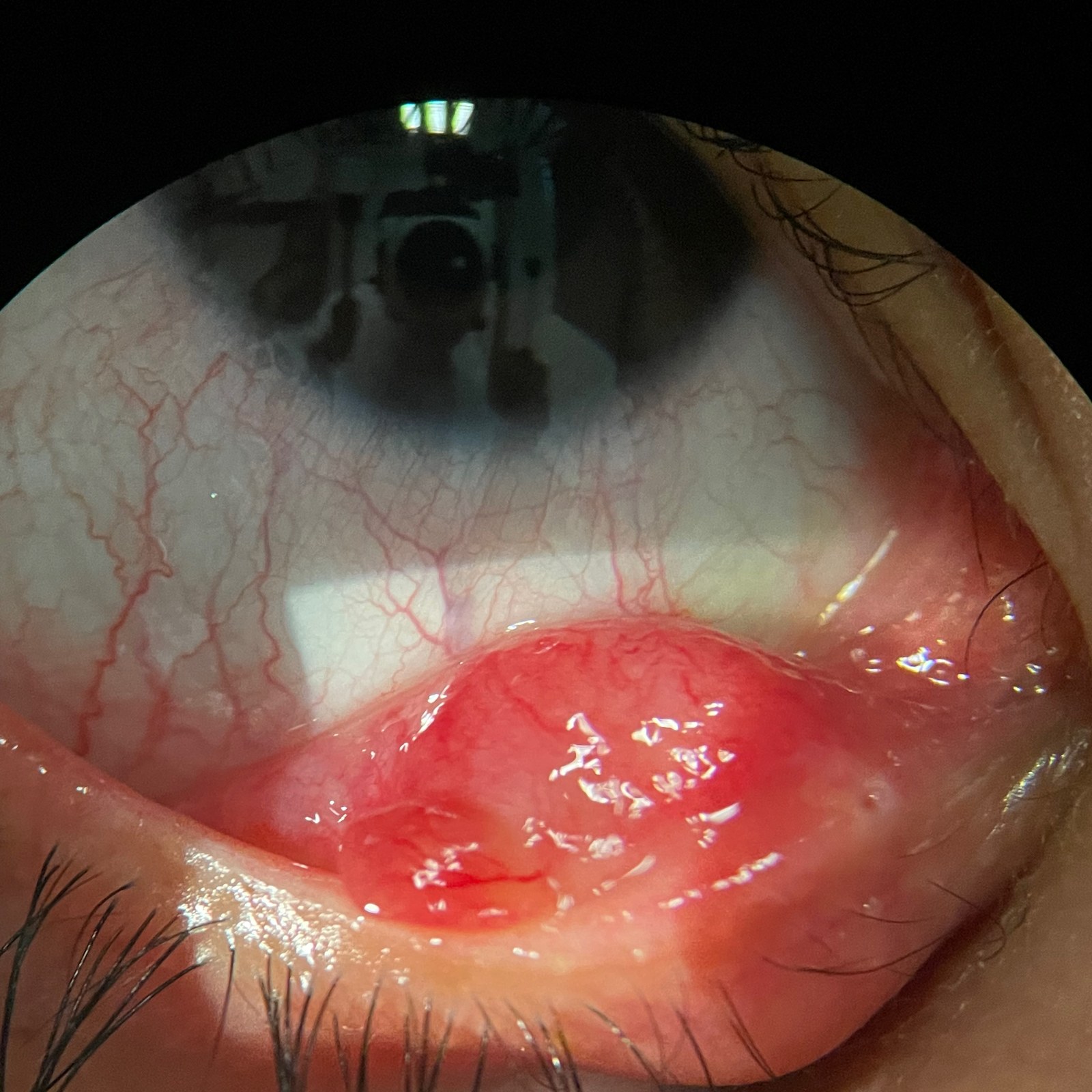 Chalazia and Styes